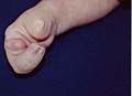 Ектродактилия на дясната ръка на едномесечно бебе