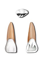 Thumbnail for Maxillary central incisor