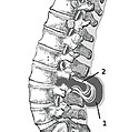 Myelomeningocele in the lumbar area (1) External sac with cerebrospinal fluid (2) Spinal cord wedged between the vertebrae