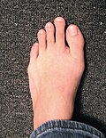 Thumbnail for Morton's toe