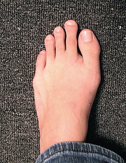 <span class="mw-page-title-main">Morton's toe</span> Type of brachymetatarsia affecting the big toe