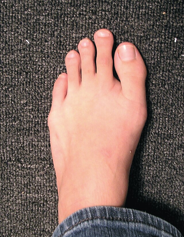 Morton's toe - Wikipedia