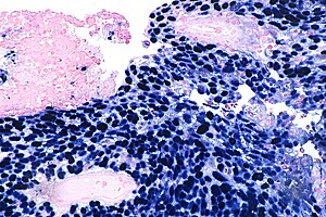 Nasopharyngeal carcinoma - EBER -- high mag.jpg