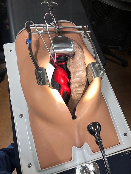 Open infrarenal aortic repair model, showing a surgical clamp above the aneurysm and below the renal arteries
