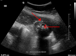 Acute cholecystitis as seen on ultrasound. The closed arrow points to gallbladder wall thickening. Open arrow points to stones in the GB