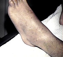 Petechiae on the lower extremities