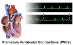 Miniatura para Contração ventricular prematura