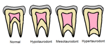 Thumbnail for Taurodontism