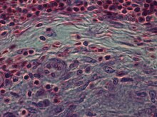 Dosya: tuberculosis epithelioid granuloma.ogv'nin dış kenarı