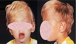 تسنّم الرأس في طفل، حيث يُري أعلى الجمجمة مثل سنام الجمل أو مثل البرج.