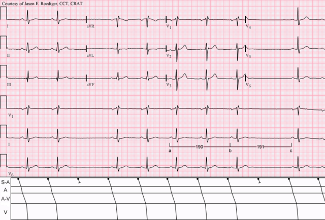 First-degree atrioventricular block - Wikipedia