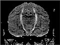 The first vector calculated image using diffusion anisotropy to show neural tracts curving through the brain in Macaca fascicularis (Filler et al. 1992)[34]