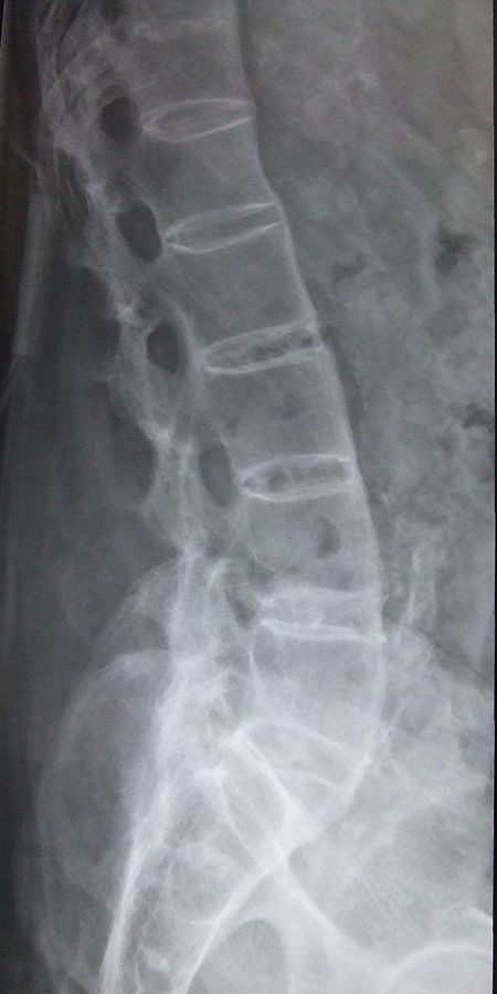 ไฟล์:Ankylosing_spondylitis_lumbar_spine.jpg