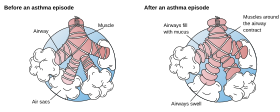 Asthma before-after-en.svg