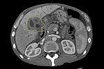 Vignette pour Cholangiocarcinome