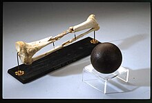 Cannonball Fracture of the Femur 1863.jpg