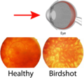 Thumbnail for Birdshot chorioretinopathy