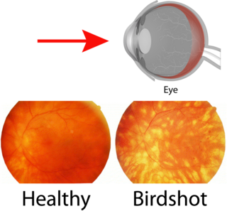 <span class="mw-page-title-main">Birdshot chorioretinopathy</span> Medical condition