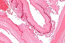 Micrograph showing the characteristic laminated cyst wall.H&E stain. Laminated liver cyst wall - high mag.jpg