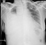 Massive right hemothorax.jpg