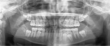 A panoramic radiograph of a 9 year old in mixed dentition Mixed dentition pan.jpg