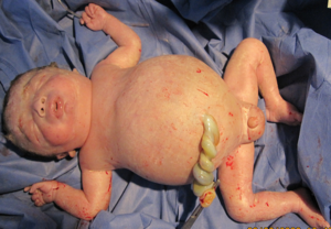 Newborn infant with severe hemolytic disease (erythroblastosis foetalis) resulting in hydrops foetalis.png