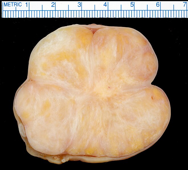 File:Ovarian Fibroma.jpg