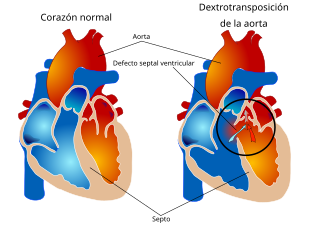 Overriding aorta diagram-es.svg