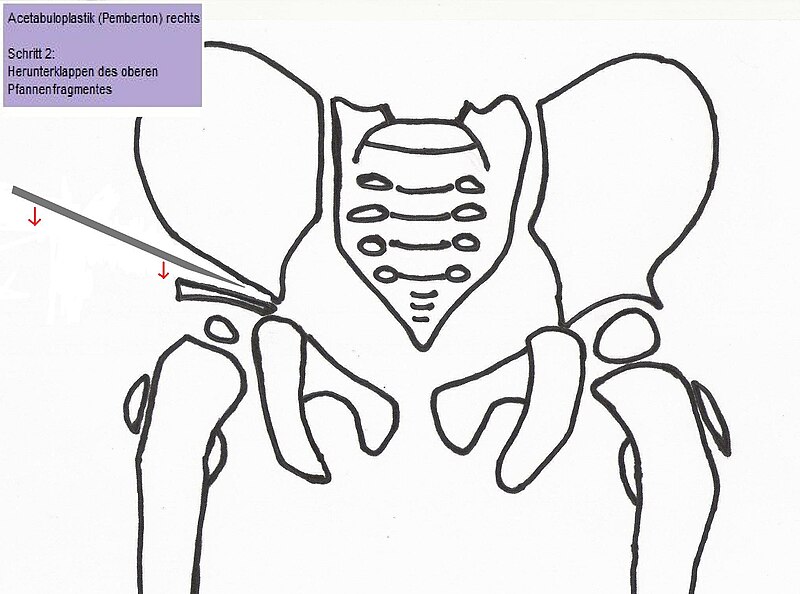 File:Pemberton-pelvic-osteotomy step2.jpg