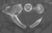 An axial CT scan showing a posterior arch defect Posterior arch defect.png