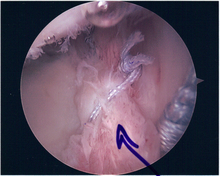 Repair of SLAP tear SLAP3.png