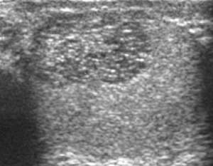 Scrotal Ultrasound