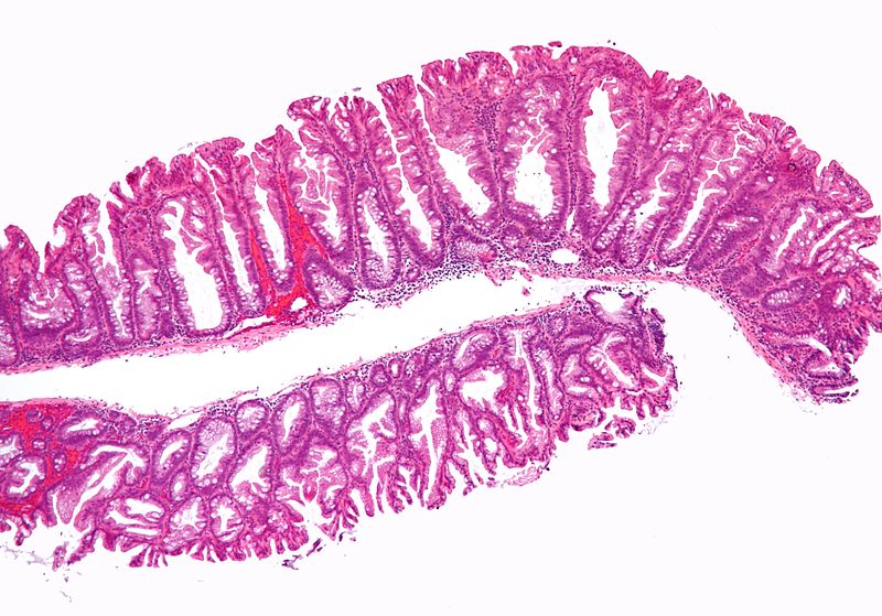 File:Sessile serrated adenoma 2 low mag.jpg