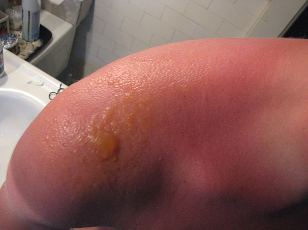 Blisters on a sunburned shoulder