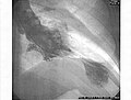 Left ventriculogram during systole displaying the characteristic apical ballooning with apical motionlessness in a patient with takotsubo cardiomyopathy