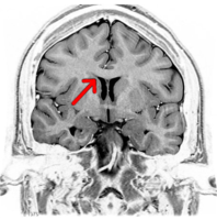 同じく核磁気共鳴画像法で見たヒト頭部。こちらは冠状断。矢印の先、側脳室（二対の黒い空洞）の上を左右に走る白っぽい灰色の部分が脳梁。