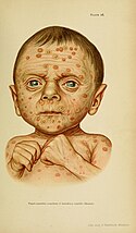 Papulopustular rash in congenital syphilis.
