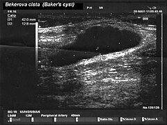 Baker's cyst.jpg