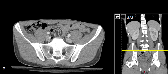 CT of a normal abdomen and pelvis, axial plane 195.png