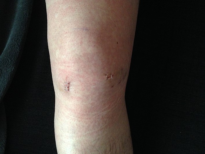 Cicatrices artroscopia de rodilla.jpg