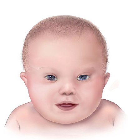 Illustration of the facial features associated with Down syndrome