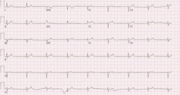 Thumbnail for File:ECG of Junctional Rhythm.png