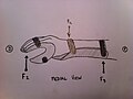 Figure 1: Force system to correct wrist flexion