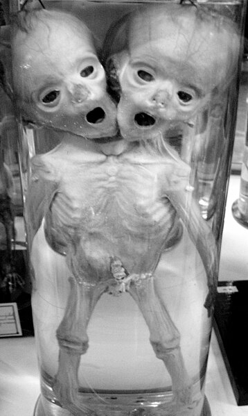 File:Human conjoined twins DSC09364.jpg