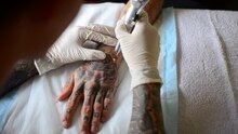 Arquivo: remoção de tatuagem a laser.ogv