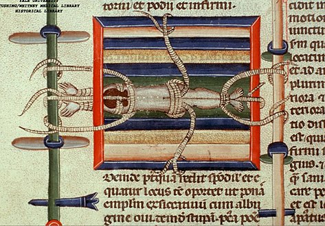 Depiction of reduction of a dislocated spine, ca. 1300