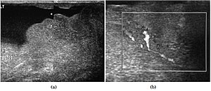 Scrotal Ultrasound