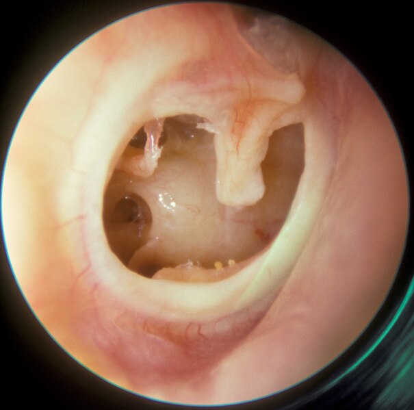 File:Subtotal Perforation of the right tympanic membrane.tif