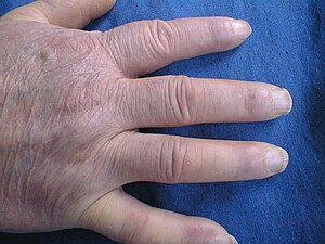 Systemic sclerosis, fingers