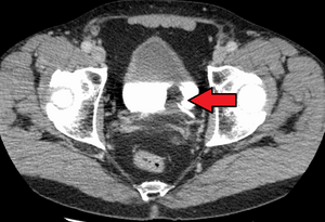 Bladder Cancer Wikipedia